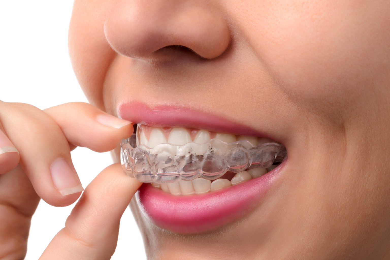 does-insurance-cover-invisalign-the-basics-explained-yuba-city