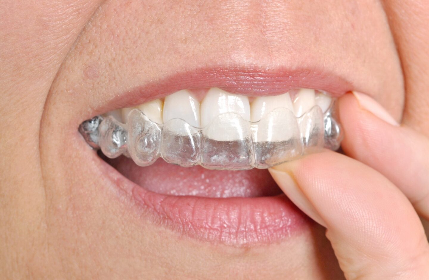 Invisalign Before and After: What To Expect and How To Prepare